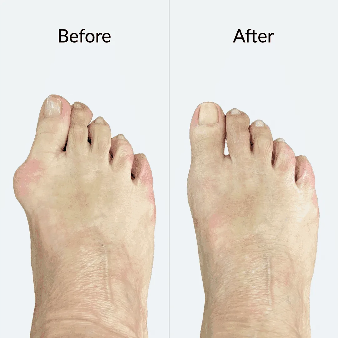 Bunion Before After 1