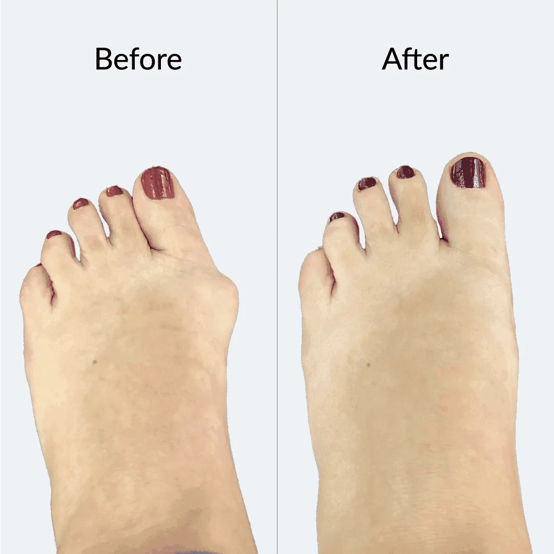 Bunion Before After 2