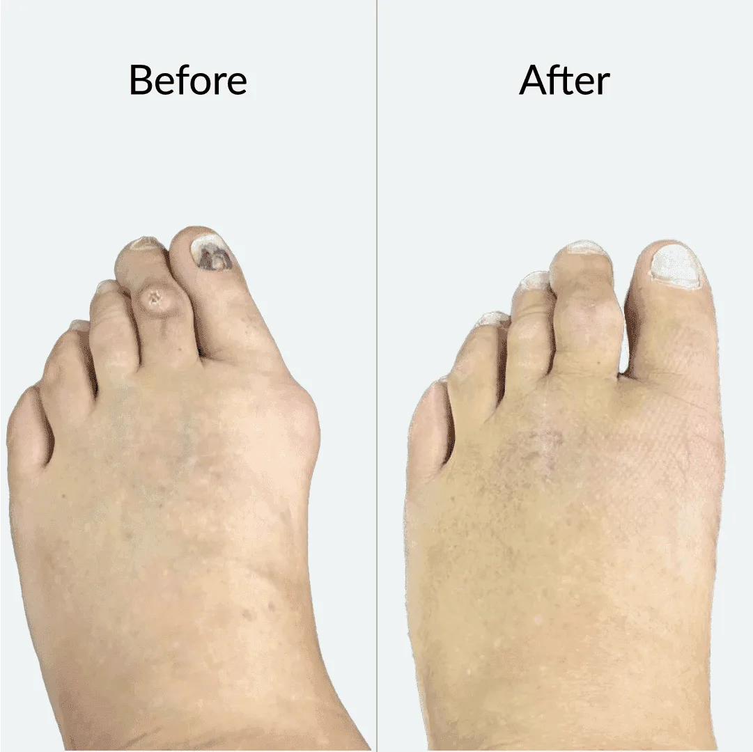 Bunion Before After 3