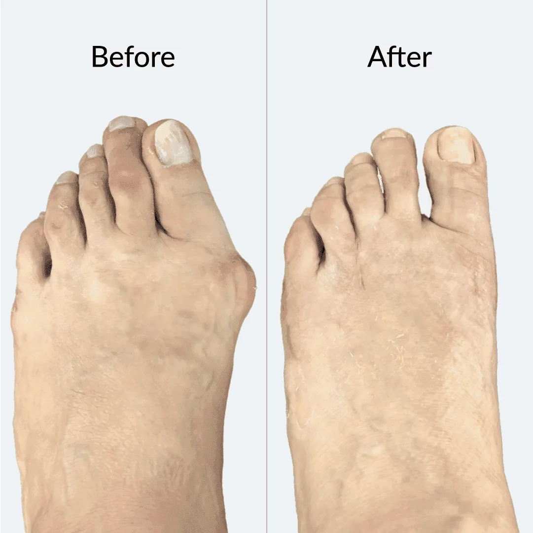 Bunion Before After 4