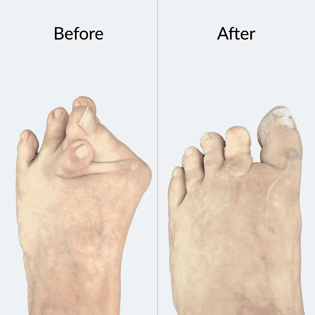 Bunion Before After 5