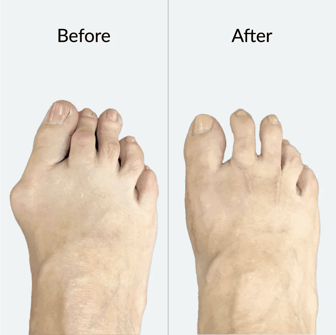 Bunion Before After 6