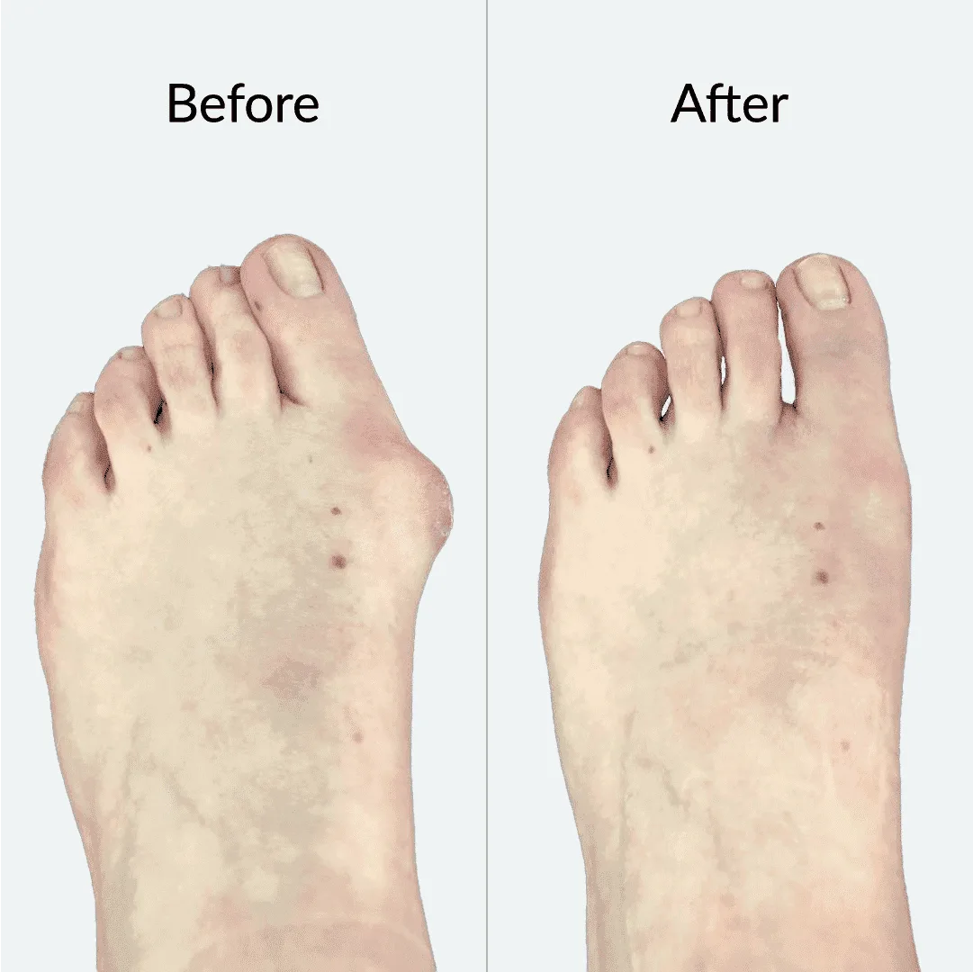 Bunion Before After 7
