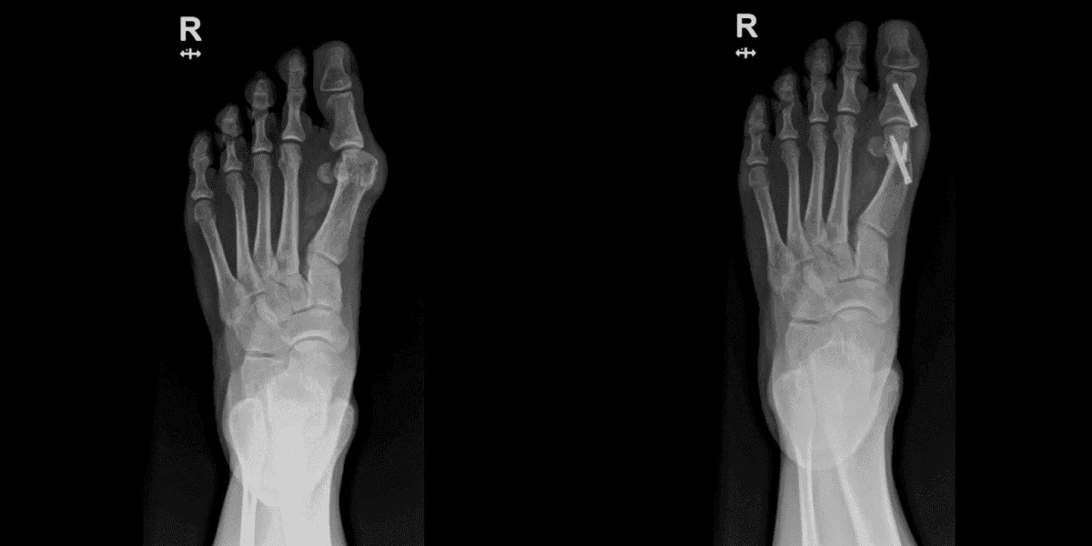 Bunion Correction Procedure 9 Surgery Procedure element