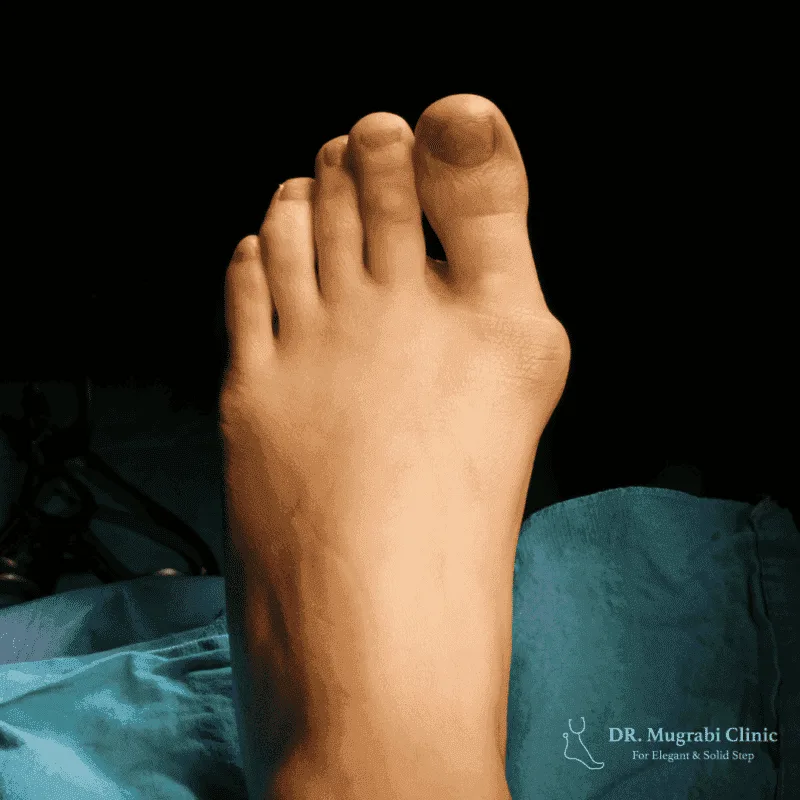 about bunion image 234